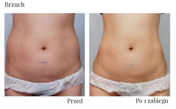 wyszczuplenie po HIFU