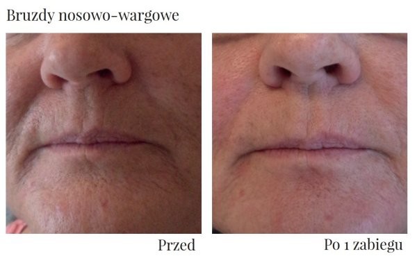 piękne usta po HIFU