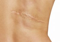 Skuteczne laserowe usuwanie blizn na ciele.