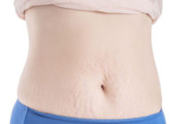 kobieta i jej brzuch z rozstępami